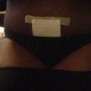 7 days POST OP!!!!! SWOLLEN BUT I THINK I LOOK GOOD!!!!