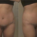 Day 17 post op. Definition is returning to my abdomen, so I guess the swelling is headed in the right direction!! I feel good and I am LOVING that low incision!!