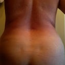 back, pre-op