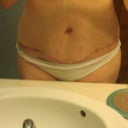 scar at 4 weeks