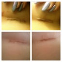 Incisions under breast (Top Left & Right 8 days Post Op) (Bottom Left & Right 29 days Post Op)