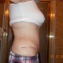 6 weeks post op