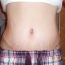 6 weeks post op