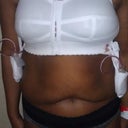 After w/ surgical bra