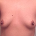 Post-op