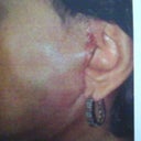after the lift, the scar was on the cheek no in the ear