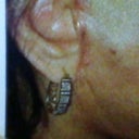 after the lift I have a line on my neck