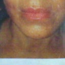 one month after the lift it looks good but after that month everything started to drop