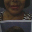 Before the surgery I did not have those deep lines around my mouth or drooping cheeks.
