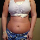 Day 2 post-op at home