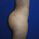 Wish Pic Side View- Got it from Dr. Jimerson's website- Patient #14