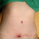 6 1/2 weeks PO - this is after my PS snipped away the skin that wasn't healing and left this hole that I'm packing with gauze - it will be sewed up this week some time.