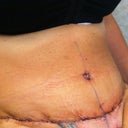 Close up of incision...hoping it will heal up nicely