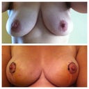 before and 2 weeks post op