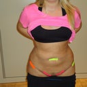 1 day post-op