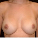 My breasts are so much better 6 months later. They look more natural and they are not too low anymore.