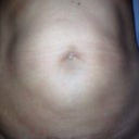 3 days before surgery. Hate it!