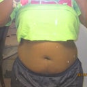 Day before surgery Front View