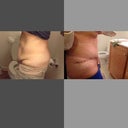 Side by side before and after