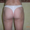 9 weeks post fat transfer