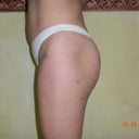 9 weeks post fat transfer