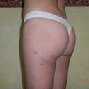 9 weeks post fat transfer.  Most is still there, but will probably need more work done.