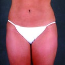 Liposuction Of The Hips, Thighs, And Abdomen