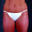 Liposuction Of The Hips, Thighs, And Abdomen