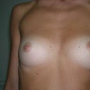 Before breast augmentation