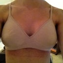 10 Days post-op