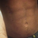 Only just over one week post surgery and I'm beginning to think Dr. Lanzer is a miracle worker!