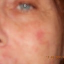 This is the day after second treatment which was red and hot almost 24 hours later. The damaged was caused even without blistering