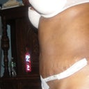 still very swollen but still not hanging over when I sit.