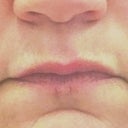 Four days after Vitrase injection in center of top lip