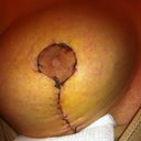 close up of right, day 8. Healing a little slower then the left side