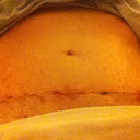 15 days post-op