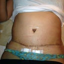 7 days PO with lots of swelling.