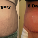 Before and Six Days Post Op
