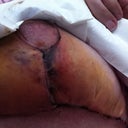 Day 8 - Bruise and dark incision line.