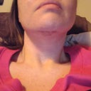 5 days post-op