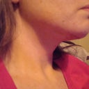 5days post-op