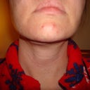 2 wks post-op