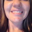2 wks post-op smile