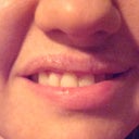 5 days post-op smile