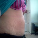 11 weeks post op standing , realllllly hope its swelling.