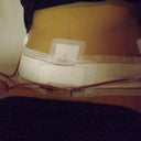 24hrs post op - no binder and 2 drains fitted