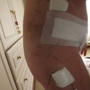 Sides are ouchy - post op day 4 - bruising starting to show