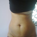 1 week before surgery