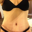 3 Weeks Post Op