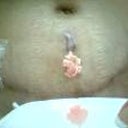 surgery from second opinion surgeon and found infection had to have open wound